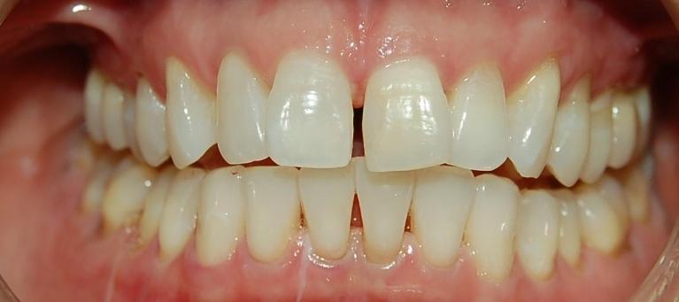 Patients front teeth with gap before dental bonding in Rockville