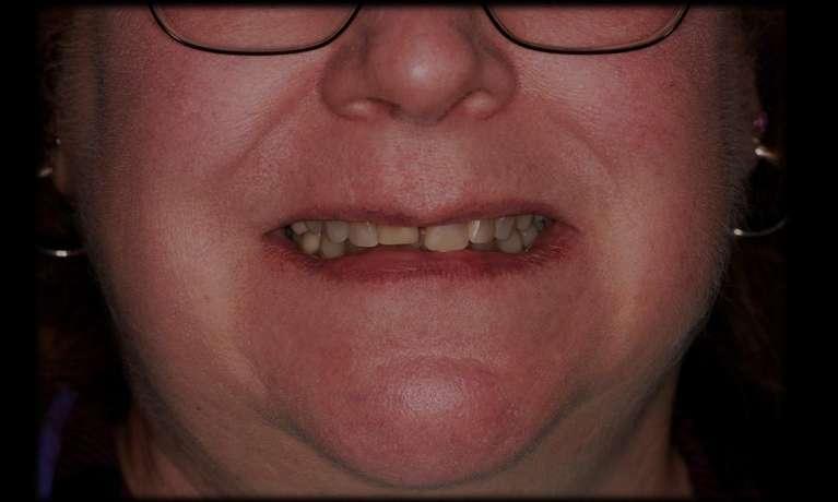 Veneers in Rockville